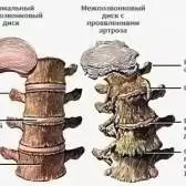 Вправи лфк при остеохондрозі поперекового відділу хребта