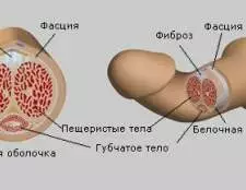 Хвороба пейроні