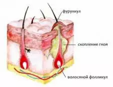 Як можна прискорити дозрівання фурункула